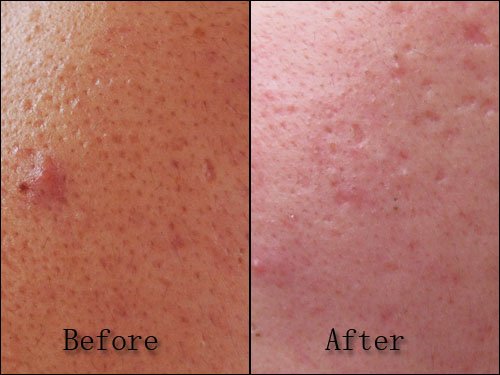 ren clearcalm 3 skincare before and after pictures